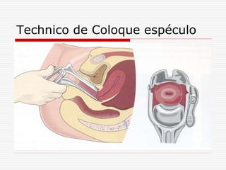 Technico de Coloque espéculo
 