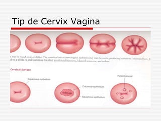 Tip de Cervix Vagina
 