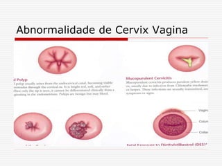 Abnormalidade de Cervix Vagina
 