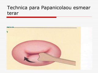 Technica para Papanicolaou esmear
terar
 