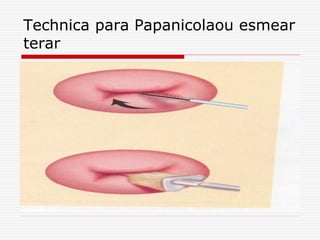 Technica para Papanicolaou esmear
terar
 