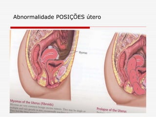 Abnormalidade POSIÇÕES útero
 