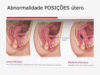 Abnormalidade POSIÇÕES útero
 