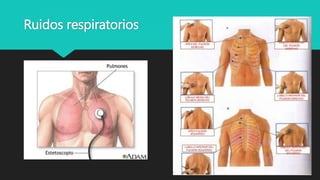 Ruidos respiratorios
 