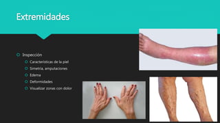 Extremidades
 Inspección
 Características de la piel
 Simetría, amputaciones
 Edema
 Deformidades
 Visualizar zonas con dolor
 