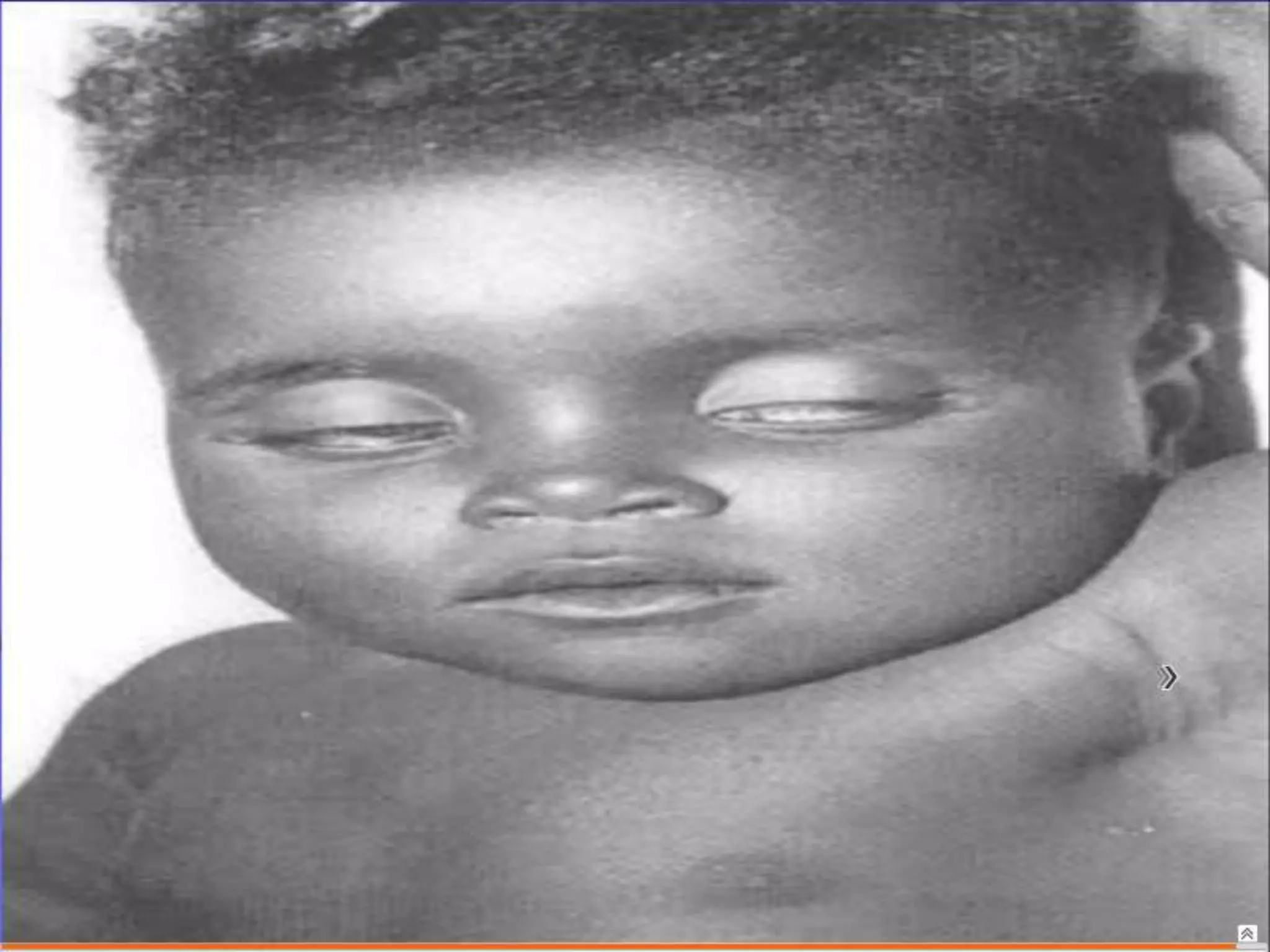 Semiología Pediatrica