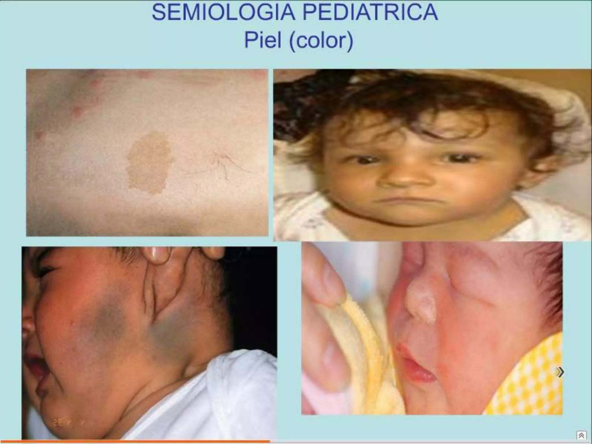 Semiología Pediatrica
