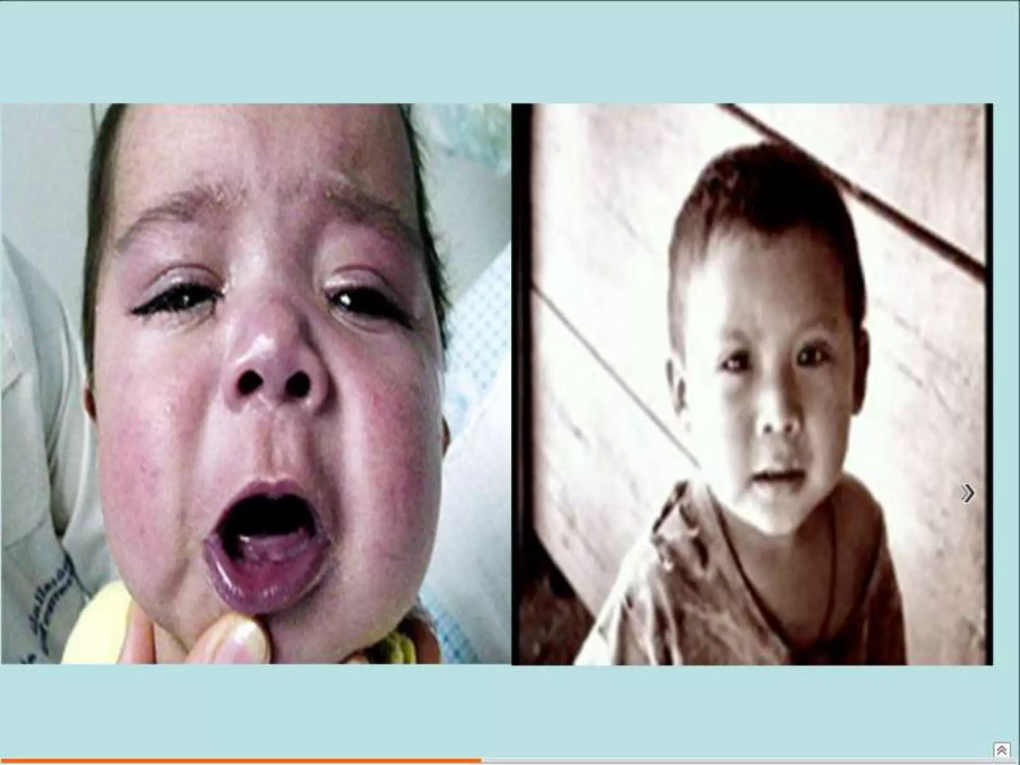 Semiología Pediatrica