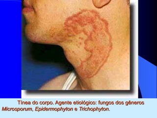 Tínea do corpo. Agente etiológico: fungos dos gêneros
Microsporum, Epidermophyton e Trichophyton.
 