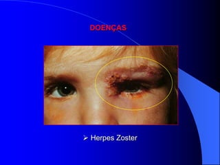 DOENÇAS




 Herpes Zoster
 