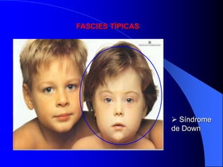 FASCIES TÍPICAS




                   Síndrome
                  de Down
 