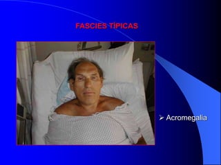 FASCIES TÍPICAS




                   Acromegalia
 