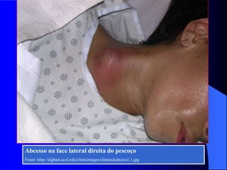 Abcesso na face lateral direita do pescoço
Fonte: http://sfghed.ucsf.edu/clinicimages/clinneckabcess1.1.jpg
 