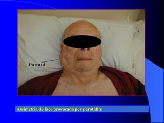Assimetria de face provocada por parotidite
 