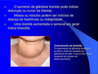         O aumento da glândula tireóide pode indicar
    disfunção ou tumor da tireóide .
        Massa ou nódulos podem ser indícios de
    doença de hashimoto ou malignidade.
        Uma tireóide aumentada e sensível em geral
    indica tireoidite.




                                   Crescimento da tireóide
                                   O crescimento da glândula tireoidiana,
                                   ou bócio, pode ser causado por
                                   deficiência do iodo, o que é uma causa
                                   freqüente em países em
                                   desenvolvimento.
 