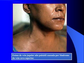 Estase de veia jugular não pulsátil causada por Síndrome
da veia cava superior.
 