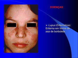 DOENÇAS




 Lupus Eritematoso:
Eritema em forma de
asa de borboleta.
 