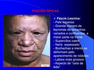 FASCIES TÍPICAS

             Fáscie Leonina:
            - Pele espessa
            - Grande número de
            lepromas de tamanhos
            variados e confluentes, a
            maior parte na fronte
            - Supercílios caem
            - Nariz espessado
            - Bochechas e mento se
            deformam pelo
            aparecimento de nódulos
            - Lábios mais grossos
            - Aspecto de “cara de
            leão”
 
