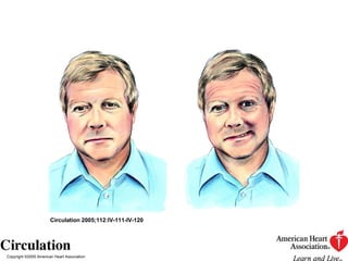Copyright ©2005 American Heart Association Circulation 2005;112:IV-111-IV-120 
