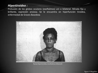 Hipertiroidea :
Protusión de los globos oculares (exoftalmos) uni o bilateral. Mirada fija y
brillante, expresión ansiosa. Se le encuentra en hiperfunción tiroidea,
enfermedad de Graves Basedow.




                        Facies hipertiroidea (exoftalmos bilateral)



                                                                          figura V Mogollón.
 
