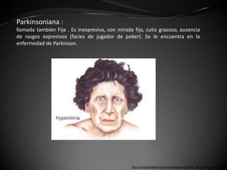 Parkinsoniana :
llamada también Fija . Es inexpresiva, con mirada fija, cutis grasoso, ausencia
de rasgos expresivos (facies de jugador de poker). Se le encuentra en la
enfermedad de Parkinson.




                                                 http://medicinageneralutesa.blogspot.com/2011_06_01_archive.html
 