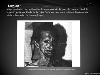 Leonina :
engrosamienlo por infiltración lepromatosa de la piel de lacara, dándole
aspecto grotesco. Cuida de la cejas. Se le encuentra en la forma lepromatosa
de la enfermedad de Hansen (Lepra)




                   Facies Leonina enfermedad de Hansen, pérdida de cola de las cejas

                                                                                       figura V III Mogollón
 