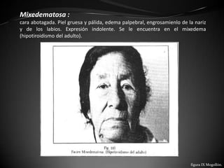 Mixedematosa :
cara abotagada. Piel gruesa y pálida, edema palpebral, engrosamienlo de la nariz
y de los labios. Expresión indolente. Se le encuentra en el mixedema
(hipotiroidismo del adulto).




                                                                         figura IX Mogollón.
 
