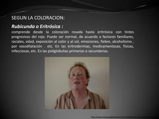 SEGUN LA COLORACION:
Rubicunda o Eritrósica :
comprende desde la coloración rosada hasta eritrósica con tintes
progresivos del rojo. Puede ser normal, de acuerdo a factores familiares,
raciales, edad, exposición al color y al sol, emociones, fiebre, alcoholismo ,
por vasodilatación . etc. En las eritrodermias, medicamentosas, físicas,
infecciosas, etc. En las poliglobulias primarias o secundarias.




                                                  http://www.clinicascatedrauno.com.ar/imagenes/cara-facies/facies-5134
 