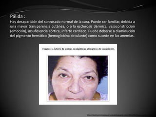 Pálida :
Hay desaparición del sonrosado normal de la cara. Puede ser familiar, debida a
una mayor transparencia cutánea, o a la esclerosis dérmica, vasoconstricción
(emoción), insuficiencia aórtica, infarto cardiaco. Puede deberse a disminución
del pigmento hemático (hemoglobina circulante) como sucede en las anemias.




                                                http://joelisemiologiaquirurgica.blogspot.com/2011/05/facies-parte-1.html
 