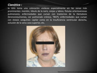 Cianótica :
la cara toma una coloración violácea especialmente en las zonas más
prominentes: mentón, lóbulo de la nariz, orejas y labios; fístulas arteriovenosas
pulmonares; enfermedades que cursan con trastornos de la Hematosis
(bronconeumonias, cor pulmonale crónico, TBCP); enfermedades que cursan
con éstasis sanguíneo capilar como en la Insuficiencia ventricular derecha,
oclusión de la vena cava superior, etc.




                                                   http://clinicascatedrauno.com.ar/imagenes/cara-facies/facies-4937
 