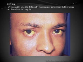 Ictérica :
Hay coloración amarilla de la piel y mucosas por aumento de la bilirrubina
circulante (más de 2 mg. %).




                                          http://juanalbasemiologiaquirurgica.blogspot.com/2011_02_01_archive.html
 