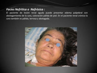 Facies Nefrítica o Nefrósica :
El paciente de lesión renal aguda puede presentar edema palpebral con
abotagamiento de la cara, coloración pálida de piel. En el paciente renal crónico la
cara también es pálida, terrosa y abotagada.
 
