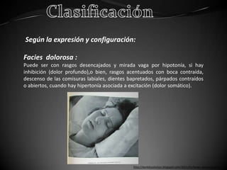 Según la expresión y configuración:

Facies dolorosa :
Puede ser con rasgos desencajados y mirada vaga por hipotonía, si hay
inhibición (dolor profundo),o bien, rasgos acentuados con boca contraída,
descenso de las comisuras labiales, dientes bapretados, párpados contraídos
o abiertos, cuando hay hipertonía asociada a excitación (dolor somático).




                                             http://darkdissolution.blogspot.com/2011/01/facies-dolorosa.html
 