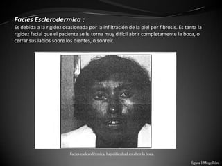 Facies Esclerodermica :
Es debida a la rigidez ocasionada por la infiltración de la piel por fibrosis. Es tanta la
rigidez facial que el paciente se le torna muy difícil abrir completamente la boca, o
cerrar sus labios sobre los dientes, o sonreír.




                          Facies esclerodérmica, hay dificultad en abrir la boca.

                                                                                    figura l Mogollón.
 
