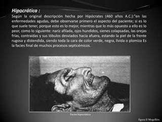 Hipocrática :
Según la original descripción hecha por Hipócrates (460 años A.C.):"en las
enfermedades agudas, debe observarse primero el aspecto del paciente; si es lo
que suele tener, porque esto es lo mejor, mientras que lo más opuesto a ello es lo
peor, como lo siguiente: nariz afilada, ojos hundidos, sienes colapsadas, las orejas
frías, contraídas y sus lóbulos desviados hacia afuera, estando la piel de la frente
rugosa y distendida, siendo toda la cara de color verde, negra, lívida o plomiza Es
la facies final de muchos procesos septicémicos.




                                    Facies hipocrática
                                                                              figura lI Mogollón.
 