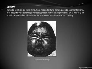 Lunar:
llamada también de luna llena. Cara redonda (luna llena), papada submentoniana,
piel delgada y de color rojo violácea; puede haber telangiectasias. En la mujer y en
el niño puede haber hirsutismo. Se encuentra en: Síndrome de Cushing.




                              Facies lunar (Cushing)




                                                                              figura lII Mogollón.
 