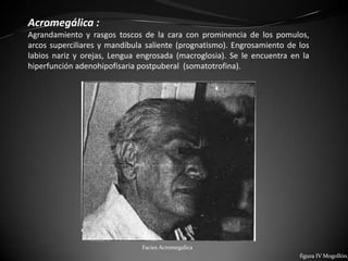 Acromegálica :
Agrandamiento y rasgos toscos de la cara con prominencia de los pomulos,
arcos superciliares y mandíbula saliente (prognatismo). Engrosamiento de los
labios nariz y orejas, Lengua engrosada (macroglosia). Se le encuentra en la
hiperfunción adenohipofisaria postpuberal (somatotrofina).




                              Facies Acromegalica
                                                                         figura IV Mogollón.
 