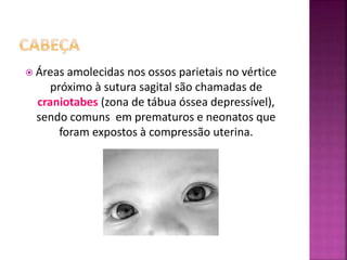  Áreas amolecidas nos ossos parietais no vértice
próximo à sutura sagital são chamadas de
craniotabes (zona de tábua óssea depressível),
sendo comuns em prematuros e neonatos que
foram expostos à compressão uterina.
 