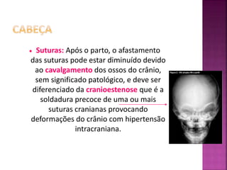  Suturas: Após o parto, o afastamento
das suturas pode estar diminuído devido
ao cavalgamento dos ossos do crânio,
sem significado patológico, e deve ser
diferenciado da cranioestenose que é a
soldadura precoce de uma ou mais
suturas cranianas provocando
deformações do crânio com hipertensão
intracraniana.
 
