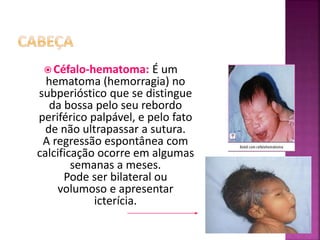  Céfalo-hematoma: É um
hematoma (hemorragia) no
subperióstico que se distingue
da bossa pelo seu rebordo
periférico palpável, e pelo fato
de não ultrapassar a sutura.
A regressão espontânea com
calcificação ocorre em algumas
semanas a meses.
Pode ser bilateral ou
volumoso e apresentar
icterícia.
 