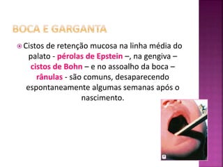  Cistos de retenção mucosa na linha média do
palato - pérolas de Epstein –, na gengiva –
cistos de Bohn – e no assoalho da boca –
rânulas - são comuns, desaparecendo
espontaneamente algumas semanas após o
nascimento.
 