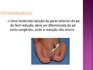  Uma moderada adução da parte anterior do pé,
de fácil redução, deve ser diferenciada do pé
torto congênito, onde a redução não ocorre.
 