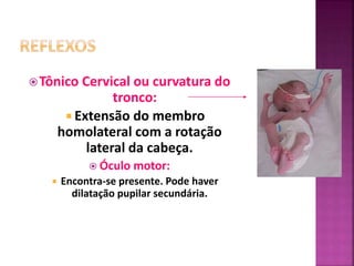 Tônico Cervical ou curvatura do
tronco:
 Extensão do membro
homolateral com a rotação
lateral da cabeça.
 Óculo motor:
 Encontra-se presente. Pode haver
dilatação pupilar secundária.
 