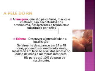  A lanugem, que são pêlos finos, macios e
imaturos, são encontrados nos
prematuros, nos lactentes a termo ela é
substituída por pêlos
 Edema - Descrever a intensidade e a
localização.
Geralmente desaparece em 24 a 48
horas, podendo ser moderado, mole,
localizado em face ao nível dos olhos e no
dorso de mãos e membros inferiores.
RN perde até 10% do peso de
nascimento.
 