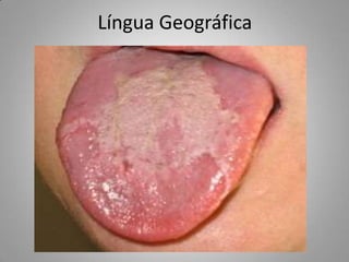 Semiologia patologias da lingua | PPTX