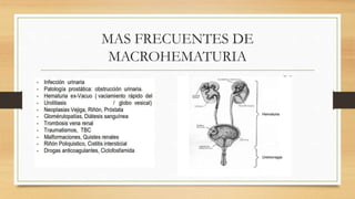 MAS FRECUENTES DE
MACROHEMATURIA
 
