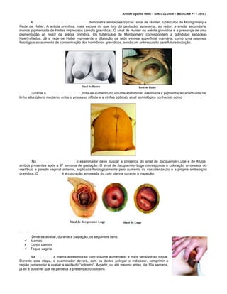 Arlindo Ugulino Netto – GINECOLOGIA – MEDICINA P7 – 2010.2


        A i n s p e ç ã o d a s m a m a s g r a v í d i c a s demonstra altera‚•es t‡picas: sinal de Hunter, tub•rculos de Montgomery e
Rede de Haller. A ar•ola primitiva, mais escura do que fora da gesta‚…o, apresenta, ao redor, a ar•ola secund„ria,
menos pigmentada de limites imprecisos (ar•ola grav‡dica). O sinal de Hunter ou ar•ola grav‡dica • a presen‚a de uma
pigmenta‚…o ao redor da ar•ola primitiva. Os tub•rculos de Montgomery correspondem a gl•ndulas seb„ceas
hipertrofiadas. J„ a rede de Haller representa a dilata‚…o da rede venosa superficial mam„ria, como uma resposta
fisiolŠgica ao aumento da concentra‚…o dos horm‘nios grav‡dicos, sendo um pr•-requisito para futura lacta‚…o.




        Durante a i n s p e ç ã o a b d o m i n a l , nota-se aumento do volume abdominal, associada a pigmenta‚…o acentuada na
linha alba (plano mediano, entre o processo xifŠide e a s‡nfise pƒbica), sinal semiolŠgico conhecido como L i n h a N i g r a .




        Na i n s p e ç ã o d a g e n i t á l i a , o examinador deve buscar a presen‚a do sinal de Jacquemier-Luge e de Kluge,
ambos presentes apŠs a 8’ semana de gesta‚…o. O sinal de Jacquemier-Luge corresponde a colora‚…o arroxeada do
vest‡bulo e parede vaginal anterior, explicada fisiologicamente pelo aumento da vasculariza‚…o e a prŠpria embebi‚…o
grav‡dica. O s i n a l d e K l u g e • a colora‚…o arroxeada do colo uterina durante a inspe‚…o.




P A L P A Ç Ã O
           Deve-se avaliar, durante a palpa‚…o, os seguintes itens:
      Mamas
      Corpo uterino
      Toque vaginal

        Na p a l p a ç ã o , a mama apresenta-se com volume aumentado e mais sens‡vel ao toque.
Durante esta etapa, o examinador dever„, com os dedos polegar e indicador, comprimir a
regi…o periareolar e avaliar a sa‡da do “colostro”. A partir, ou at• mesmo antes, da 10a semana,
j„ se • poss‡vel que se perceba a presen‚a do colostro.
                                                                                                                                   11
 