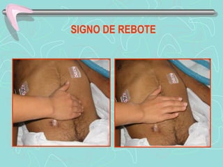 SIGNO DE REBOTE
 