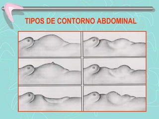 TIPOS DE CONTORNO ABDOMINAL
 