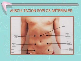 AUSCULTACION SOPLOS ARTERIALES
 